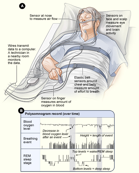 Philips Respironics Alice 6 LDxN Diagnostic Sleep System (Full ...