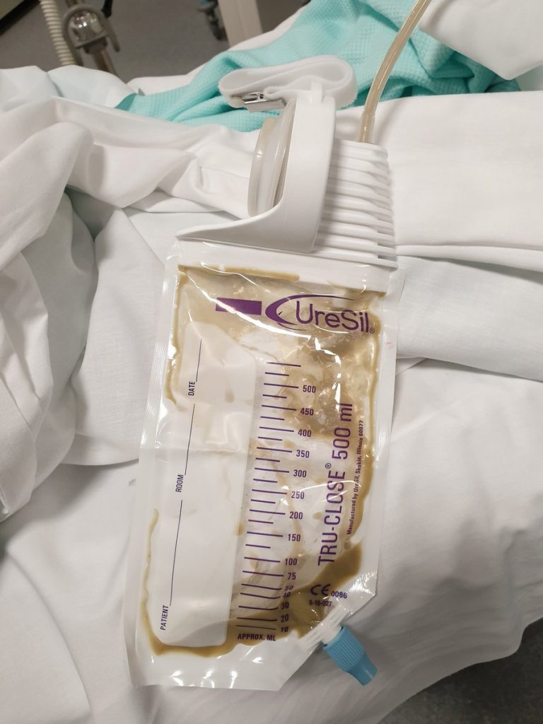 Uresil TRUCLOSE Suction Drainage System Compass Medical